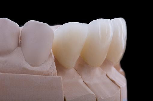 DIFFERENCE BETWEEN PORCELAIN AND CERAMIC DENTAL CROWNS