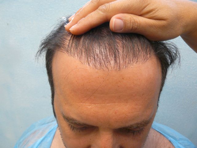 hair transplant