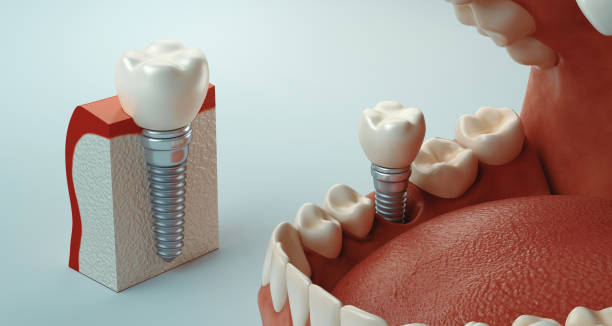 Affordable Dental Implants Houston