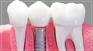 Pros and Cons of Dental Implants