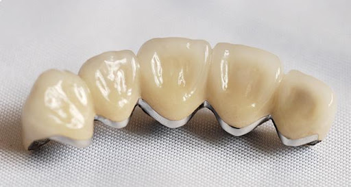 Metal Ceramic Crown For Teeth Good or Bad