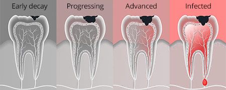Tooth Cavities Symptoms And Causes