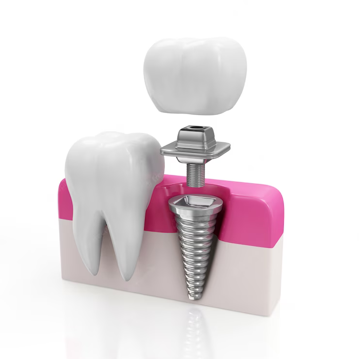 dental implants benton ar