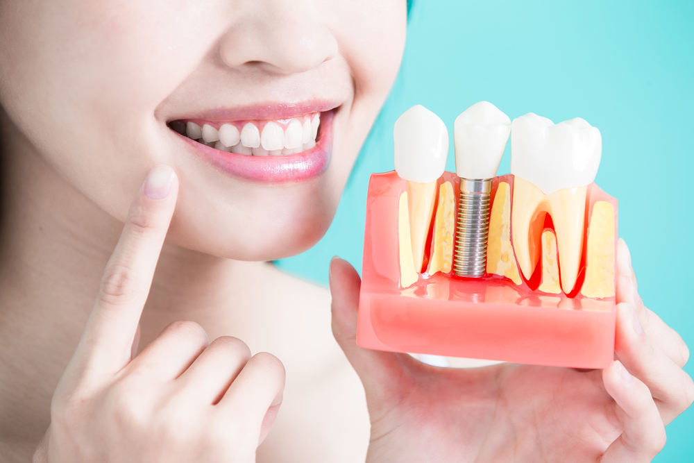 Bringing Back Your Smile: A Guide to Dental Implants