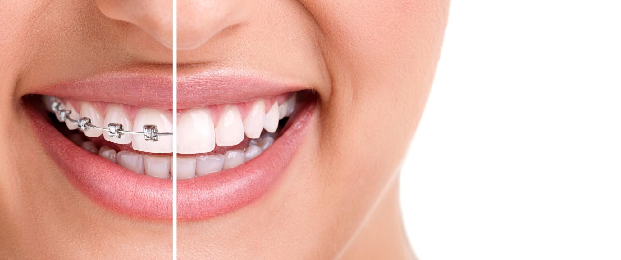The ABCs of Braces: A Guide to Straightening Your Smile