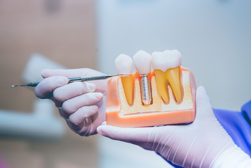 cost of dental implants santa rosa beach fl