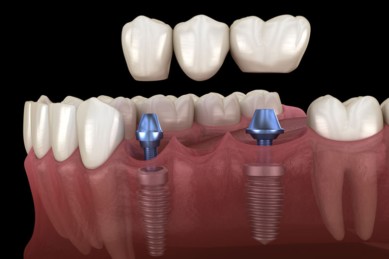 The Complete Guide to Dental Implants in Lincoln, AL