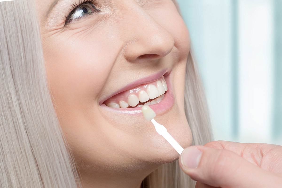 Why Choose Veneers in West Houston?