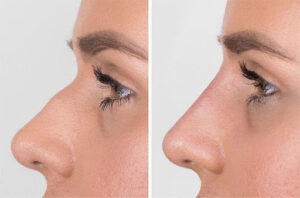 Understand Facial Proportions And Breast Reduction Options