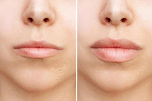 Upper Lip, Lower Lip: How Anatomy Shapes Where Filler Goes